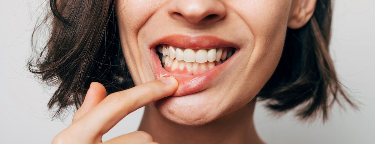 Krvácanie z ďasien: Podľa zubnej lekárky má tieto príčiny